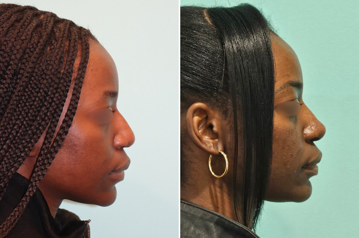 Before and after Revision Rhinoplasty by Dr. Shervin Naderi, Patient 46971