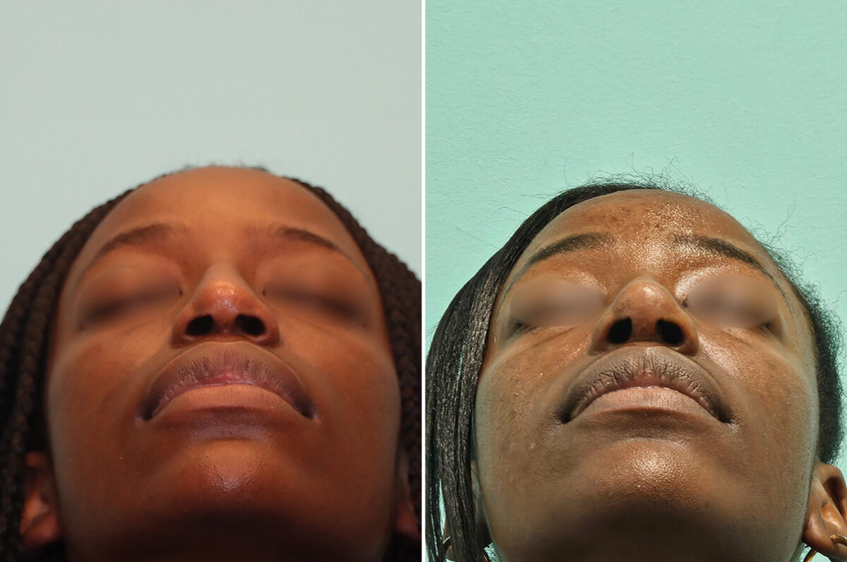 Before and after Revision Rhinoplasty by Dr. Shervin Naderi, Patient 46971