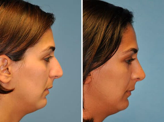 Before and after Rhinoplasty by Dr. Shervin Naderi, Patient 8837