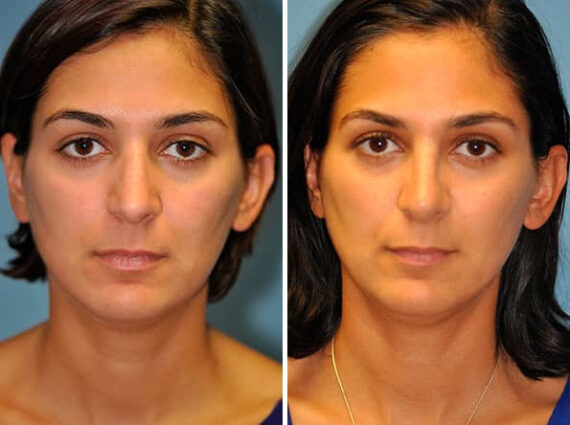 Before and after Rhinoplasty by Dr. Shervin Naderi, Patient 8837