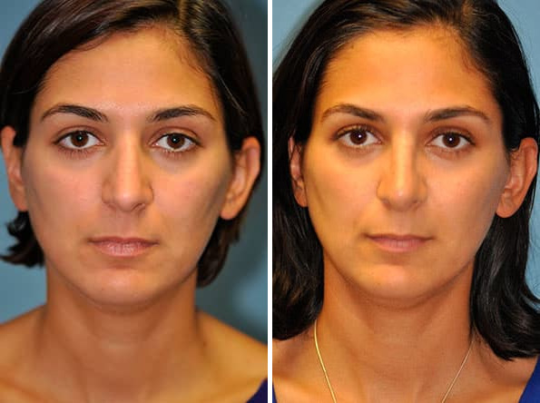 Before and after Rhinoplasty by Dr. Shervin Naderi, Patient 8837
