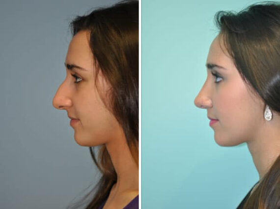 Before and after Rhinoplasty by Dr. Shervin Naderi, Patient 8839
