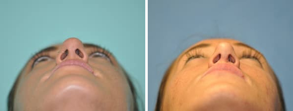 Before and after Rhinoplasty by Dr. Shervin Naderi, Patient 8840