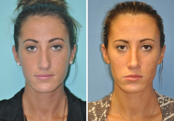 Before and after Rhinoplasty by Dr. Shervin Naderi, Patient 8840