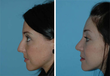 Before and after Rhinoplasty by Dr. Shervin Naderi, Patient 8841