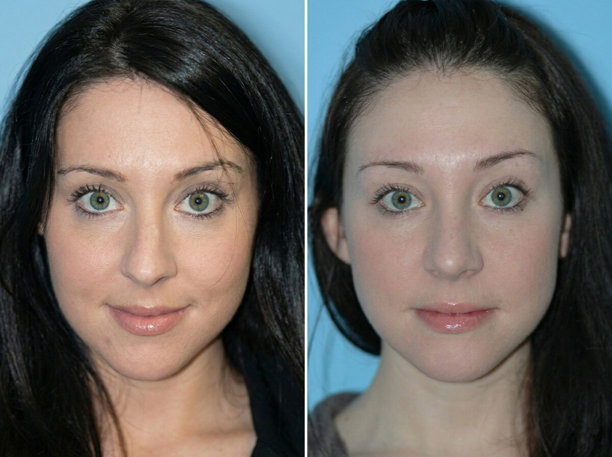 Before and after Rhinoplasty by Dr. Shervin Naderi, Patient 8841