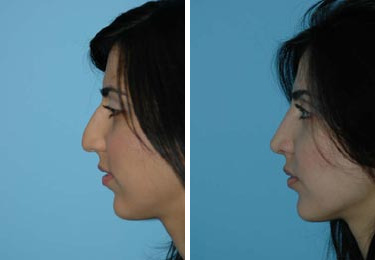 Before and after Rhinoplasty by Dr. Shervin Naderi, Patient 8844