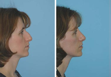 Before and after Rhinoplasty by Dr. Shervin Naderi, Patient 8845