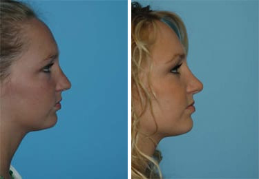 Before and after Rhinoplasty by Dr. Shervin Naderi, Patient 8846