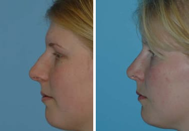 Before and after Rhinoplasty by Dr. Shervin Naderi, Patient 8847