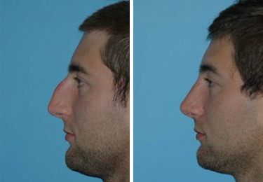Before and after Rhinoplasty by Dr. Shervin Naderi, Patient 8848