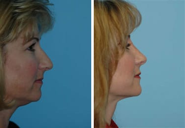 Before and after Rhinoplasty by Dr. Shervin Naderi, Patient 8850