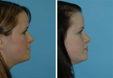 Before and after Rhinoplasty by Dr. Shervin Naderi, Patient 8851