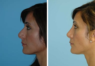 Before and after Rhinoplasty by Dr. Shervin Naderi, Patient 8853