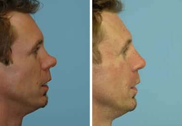 Before and after Rhinoplasty by Dr. Shervin Naderi, Patient 8854