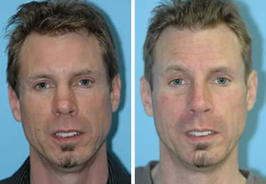 Before and after Rhinoplasty by Dr. Shervin Naderi, Patient 8854