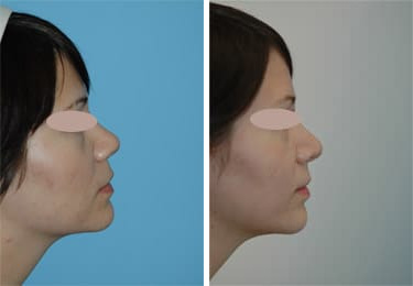 Before and after Rhinoplasty by Dr. Shervin Naderi, Patient 8855