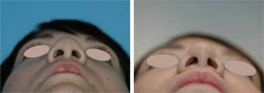 Before and after Rhinoplasty by Dr. Shervin Naderi, Patient 8855