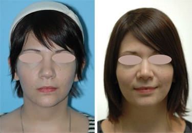 Before and after Rhinoplasty by Dr. Shervin Naderi, Patient 8855