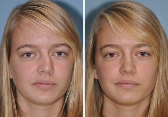 Before and after Rhinoplasty by Dr. Shervin Naderi, Patient 8857