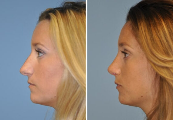 Before and after Rhinoplasty by Dr. Shervin Naderi, Patient 8858