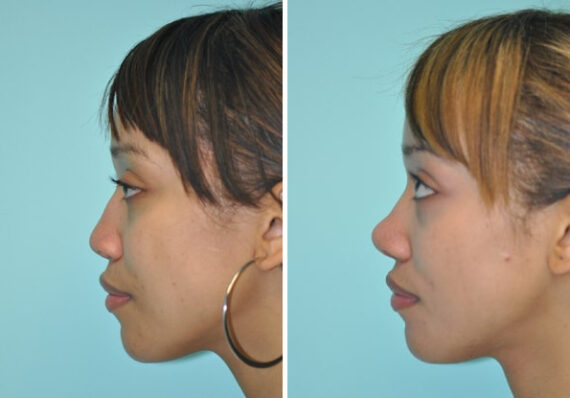 Before and after Rhinoplasty by Dr. Shervin Naderi, Patient 8860