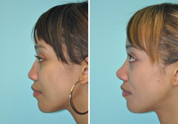 Before and after Rhinoplasty by Dr. Shervin Naderi, Patient 8860