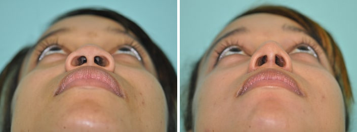 Before and after Rhinoplasty by Dr. Shervin Naderi, Patient 8860