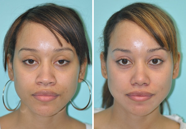 Before and after Rhinoplasty by Dr. Shervin Naderi, Patient 8860