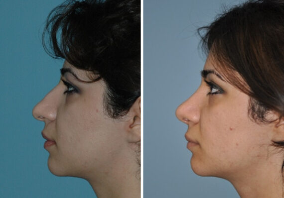 Before and after Rhinoplasty by Dr. Shervin Naderi, Patient 8861