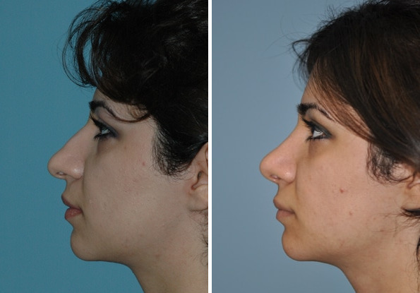 Before and after Rhinoplasty by Dr. Shervin Naderi, Patient 8861