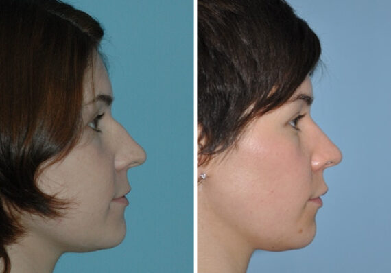 Before and after Rhinoplasty by Dr. Shervin Naderi, Patient 8863