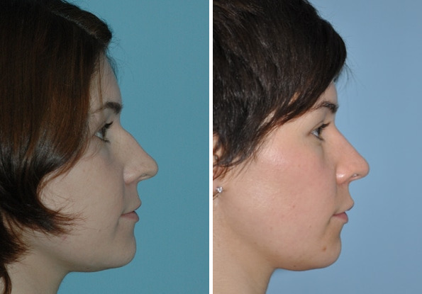 Before and after Rhinoplasty by Dr. Shervin Naderi, Patient 8863