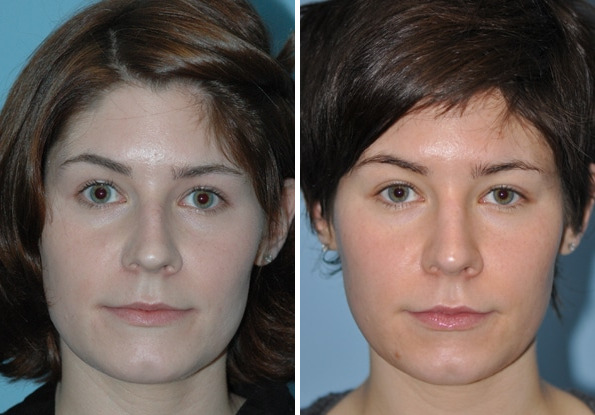 Before and after Rhinoplasty by Dr. Shervin Naderi, Patient 8863