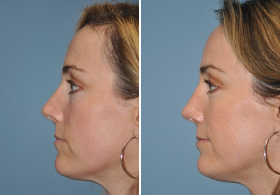 Before and after Rhinoplasty by Dr. Shervin Naderi, Patient 8864