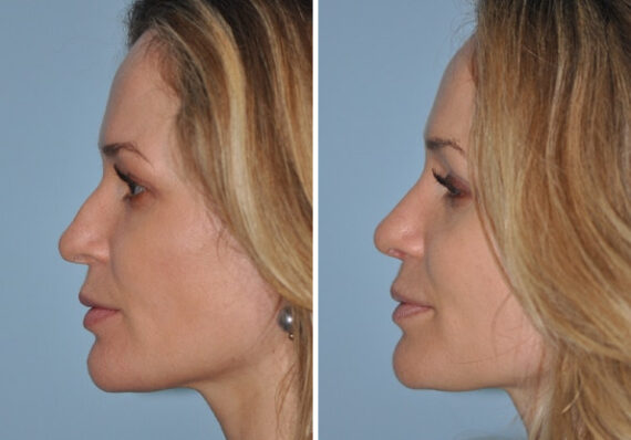Before and after Rhinoplasty by Dr. Shervin Naderi, Patient 8865