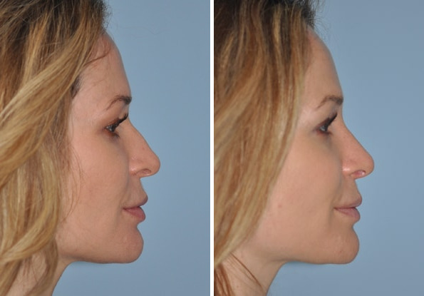 Before and after Rhinoplasty by Dr. Shervin Naderi, Patient 8865
