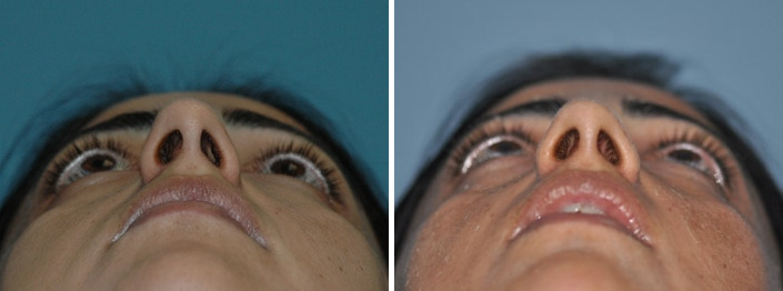 Before and after Rhinoplasty by Dr. Shervin Naderi, Patient 8866