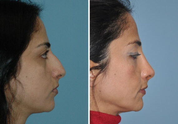 Before and after Rhinoplasty by Dr. Shervin Naderi, Patient 8866