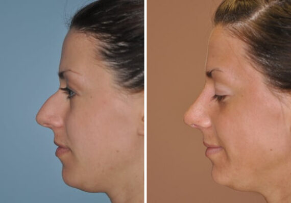 Before and after Rhinoplasty by Dr. Shervin Naderi, Patient 8867