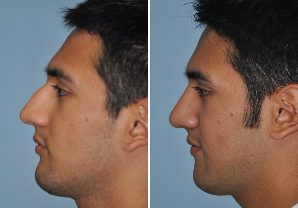 Before and after Rhinoplasty by Dr. Shervin Naderi, Patient 8868