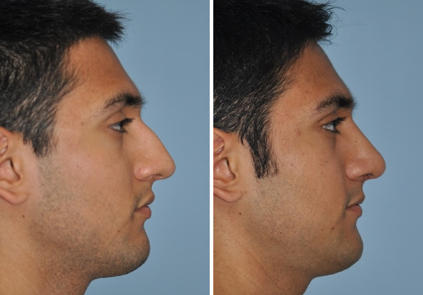 Before and after Rhinoplasty by Dr. Shervin Naderi, Patient 8868
