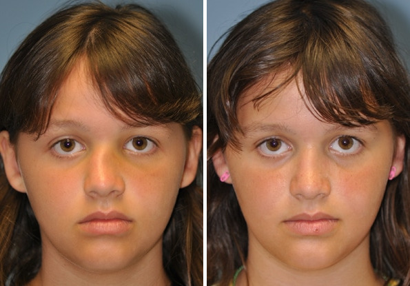 Before and after Rhinoplasty by Dr. Shervin Naderi, Patient 8869