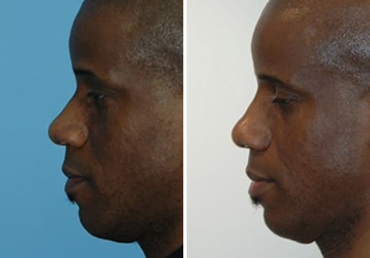Before and after Rhinoplasty by Dr. Shervin Naderi, Patient 8871