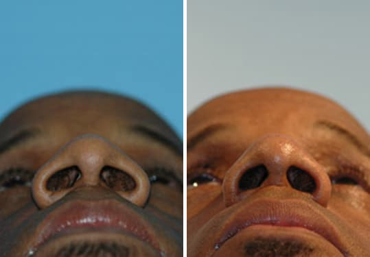 Before and after Rhinoplasty by Dr. Shervin Naderi, Patient 8871