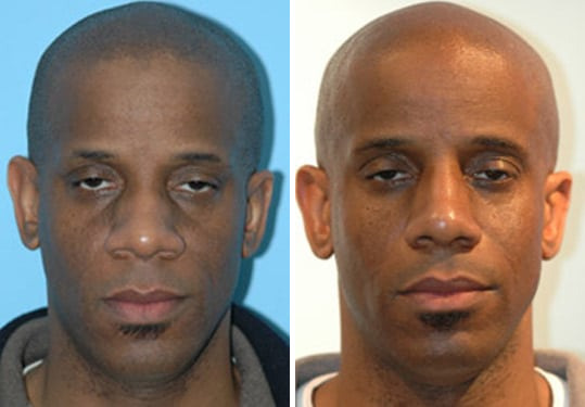 Before and after Rhinoplasty by Dr. Shervin Naderi, Patient 8871