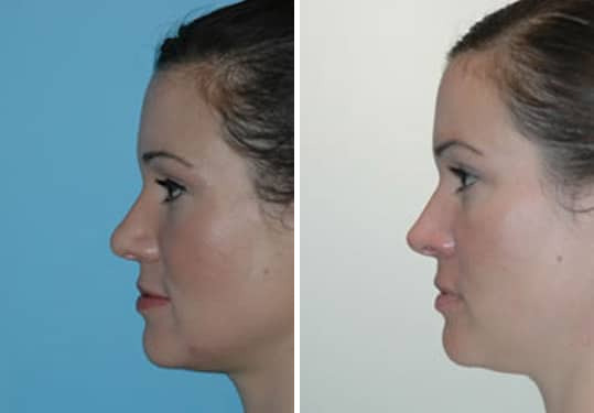 Before and after Rhinoplasty by Dr. Shervin Naderi, Patient 8872