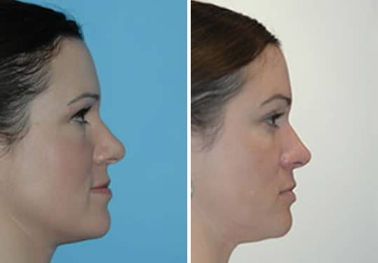 Before and after Rhinoplasty by Dr. Shervin Naderi, Patient 8872
