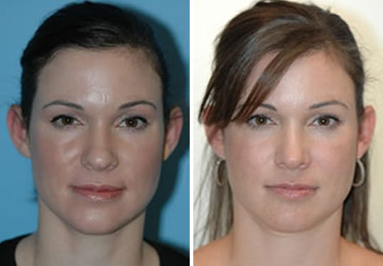 Before and after Rhinoplasty by Dr. Shervin Naderi, Patient 8872