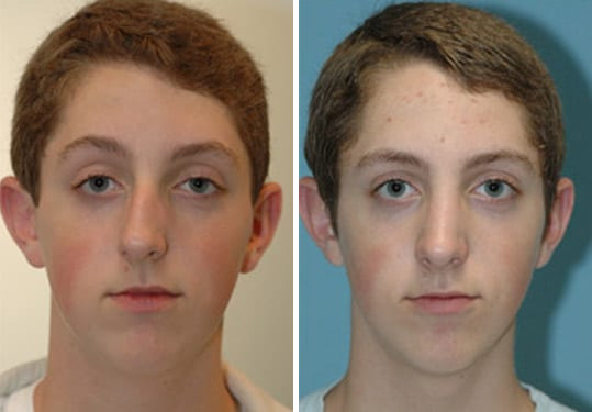 Before and after Rhinoplasty by Dr. Shervin Naderi, Patient 8874